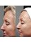 Spa Luxe Med Spa - Thread lift skin tightening treatment results 