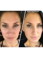 Facial Rejuvenation - Spa Luxe Med Spa