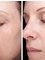 Skin Vitality Medical Clinic - Hamilton - skin Before & After  