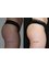 Skin Vitality Medical Clinic - Hamilton - non invasive butt lift Before & After  