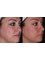 Skin Vitality Medical Clinic - Hamilton - Radio Frequency Facial  