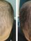 Skin Vitality Medical Clinic - Hamilton - Hair Before & After 