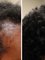 Skin Vitality Medical Clinic - Hamilton -  Hair Before & After 