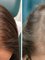Skin Vitality Medical Clinic - Stoney Creek - Hair Before & After 