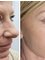 Skin Vitality Medical Clinic - Stoney Creek - Skin Before & After  