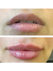 Lip Augmentation - Pureglo Clinic