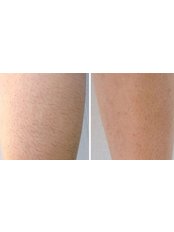 Laser Hair Removal - Pureglo Clinic