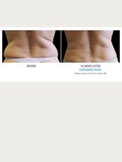 Skin Vitality Medical Clinic - Milton - CoolSculpting Before & After