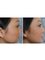 Skin Vitality Medical Clinic - Milton - Dermal Chin Filler Before & After 