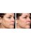 Skin Vitality Medical Clinic - Milton - Fraxel Face Before & After 