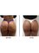 Skin Vitality Medical Clinic - Milton - Nonsurgical Butt Lift Before & After  