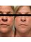 Skin Vitality Medical Clinic - Milton - Morpheus Before & After 