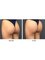 Skin Vitality Medical Clinic - Milton - Nonsurgical Butt Lift Before & After  