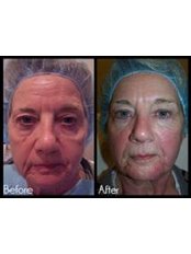 Treatment for Wrinkles - Hertitage Way Medical Spa