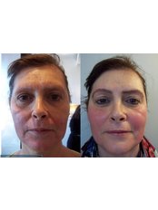 Treatment for Wrinkles - Hertitage Way Medical Spa