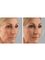 Skin Vitality Medical Clinic - Oakville - Dermal Cheek Filler Before & After 