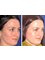 Skin Vitality Medical Clinic - Oakville - Facial Rejuvenation Before & After  