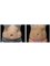 Skin vitality Medical Clinic – Oakville - Emsculpt-Abs Before & After 