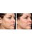 Skin Vitality Medical Clinic - Oakville - Fraxel Face Before & After 