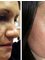 Skin vitality Medical Clinic – Oakville - skin Before & After  