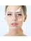 Genesis Medi Clinic - M22®ResurFX™ treatment is a fractional skin rejuvenation solution 