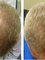 Skin Vitality Medical Clinic - Richmond Hill -  Hair Before & After 