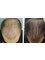 Skin Vitality Medical Clinic - St Catharines - Hair Before & After 