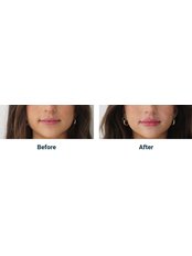 Lip Filler - Skinjectables Cosmetic Clinic