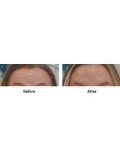 Treatment for Wrinkles - Skinjectables Cosmetic Clinic