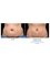 Skin Vitality Medical Clinic - CoolSculpting Before & After 