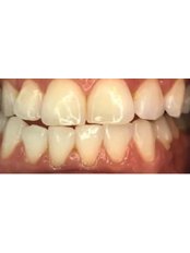 Teeth Whitening - Brock Street Beauty Bar