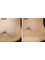 Skin Vitality Medical Clinic - Whitby - Radio Frequency Skin Tightening  