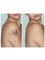 Hometown Laser Clinic and Spa - tattoo removal 