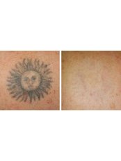 Tattoo Removal - Hometown Laser Clinic and Spa