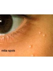 Milia Removal - Hometown Laser Clinic and Spa