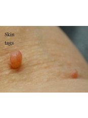 Skin Tag Removal - Hometown Laser Clinic and Spa