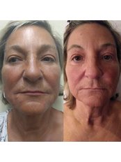 Non-Surgical Facelift - DermaCure Clinic