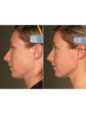 Laser skin tightening  - DermaCure Clinic