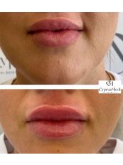Lip Filler - CyprusMedi Clinic