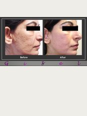 Gizele Clinic - Co2 fractional post acne scars