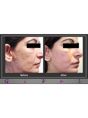 Gizele Clinic - Co2 fractional post acne scars 