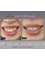 Gizele Clinic - gummy smile (non surgical) 