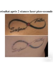 Laser Tattoo removal Pico-second ALMA Lasers - Centre Laser Détatouage & Esthétique