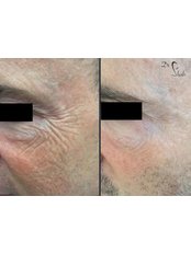 Treatment for Wrinkles - Dr. Med. Arna Shab
