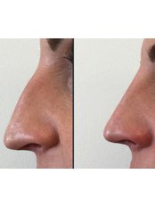 Non-Surgical Nose Job - Dr. Med. Arna Shab