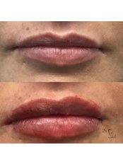 Lip Augmentation - Dr. Med. Arna Shab