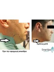 SmartLipo™ - Smart Lipo Clinic