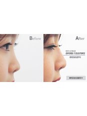 Non-Surgical Nose Job - Skin & Beam