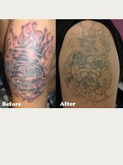 Hong Kong Laser Tattoo Removal Clinic - 1/F Winning House, 28 Hollywood Road, Central, 