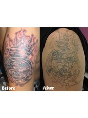 Hong Kong Laser Tattoo Removal Clinic - 1/F Winning House, 28 Hollywood Road, Central,  0